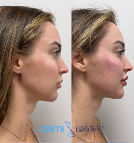 Dermal Fillers case #72491