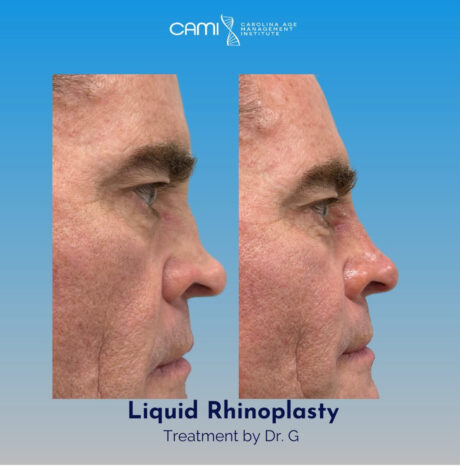 Liquid Rhinoplasty case #72647