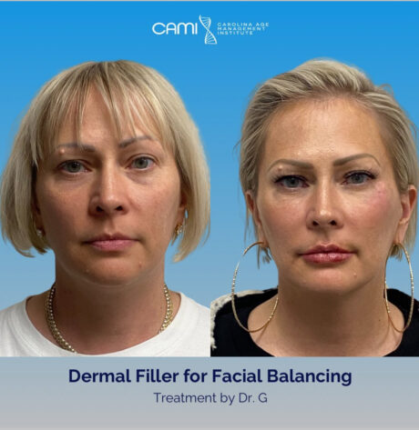 Dermal Fillers case #72498