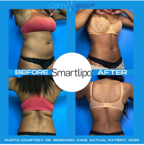 SmartLipo case #72549