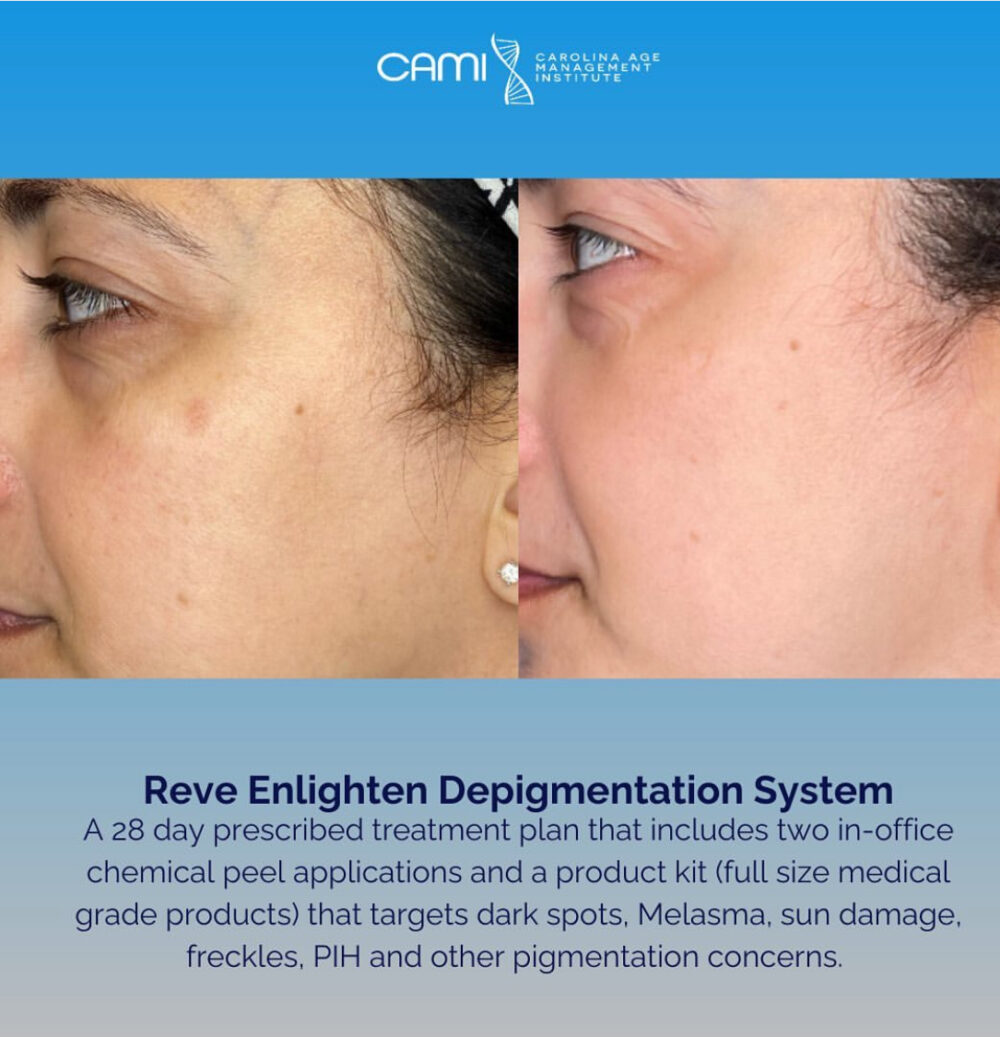 Reve Enlighten Peel case #72670