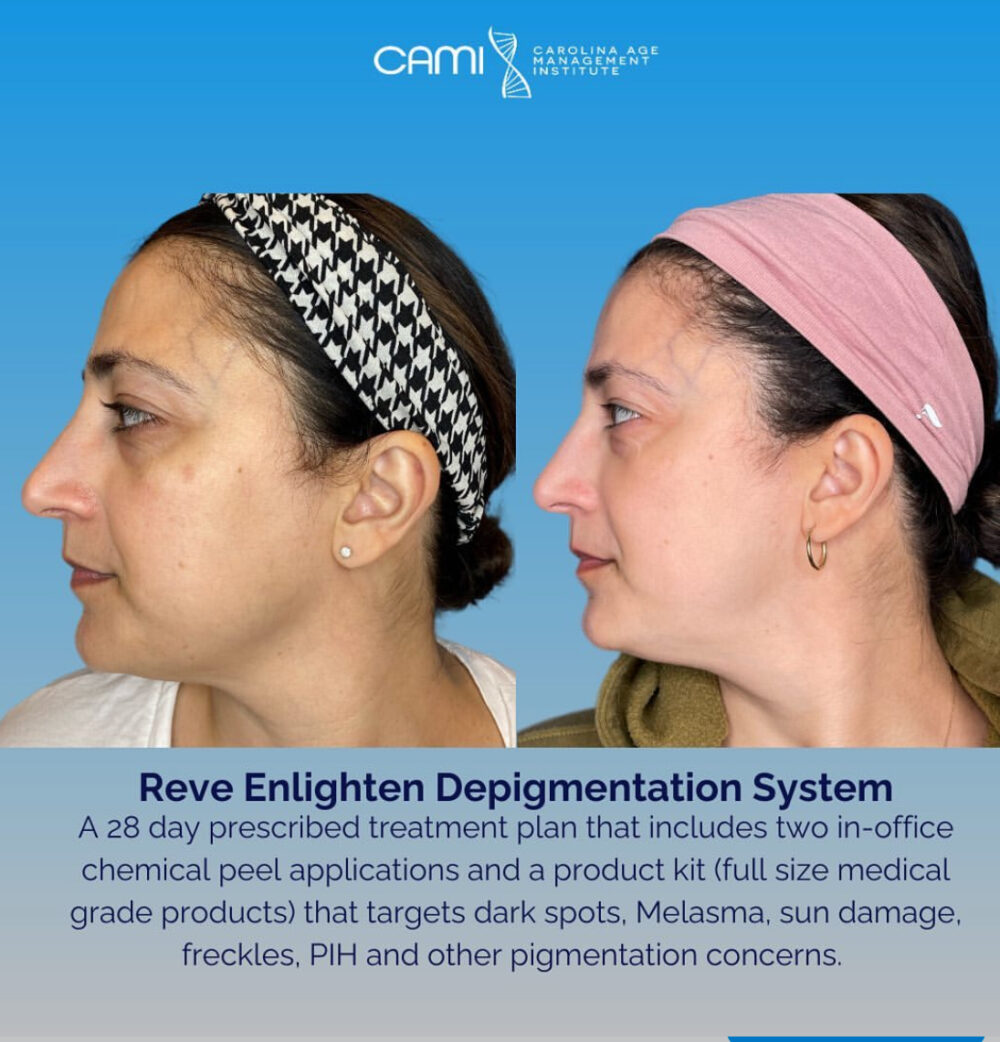 Reve Enlighten Peel case #72670