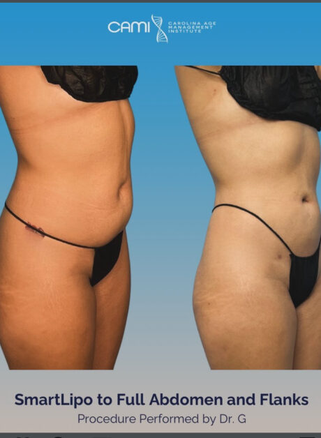 SmartLipo case #72583