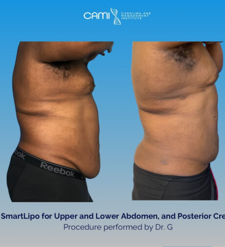 SmartLipo case #72585