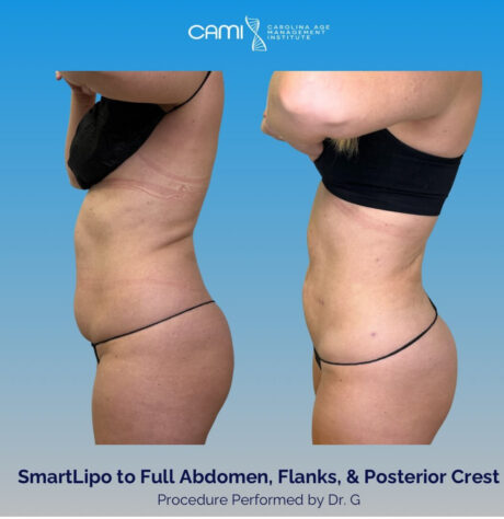 SmartLipo case #72587