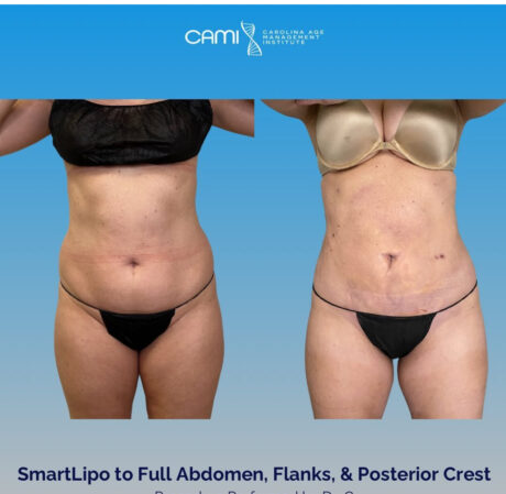 SmartLipo case #72589