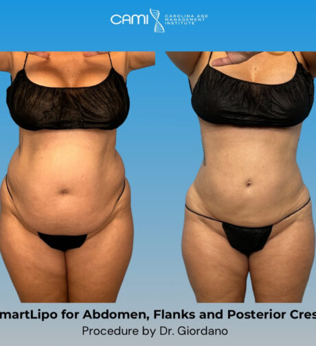 SmartLipo case #72591