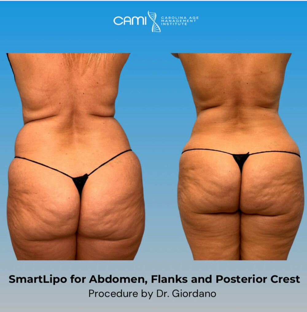 SmartLipo case #72593