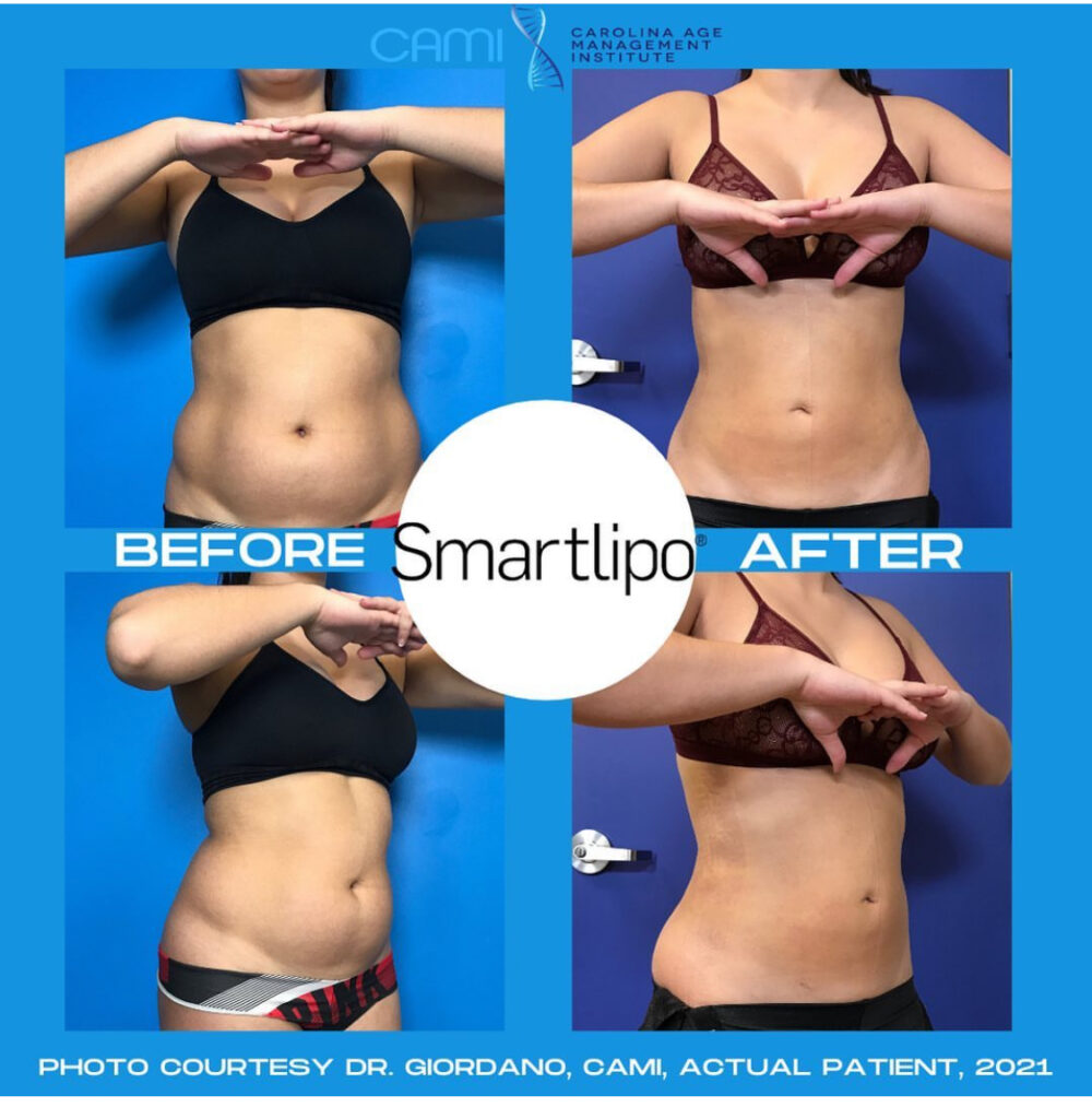 SmartLipo case #72551