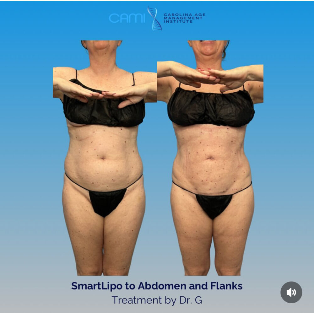 SmartLipo case #72595