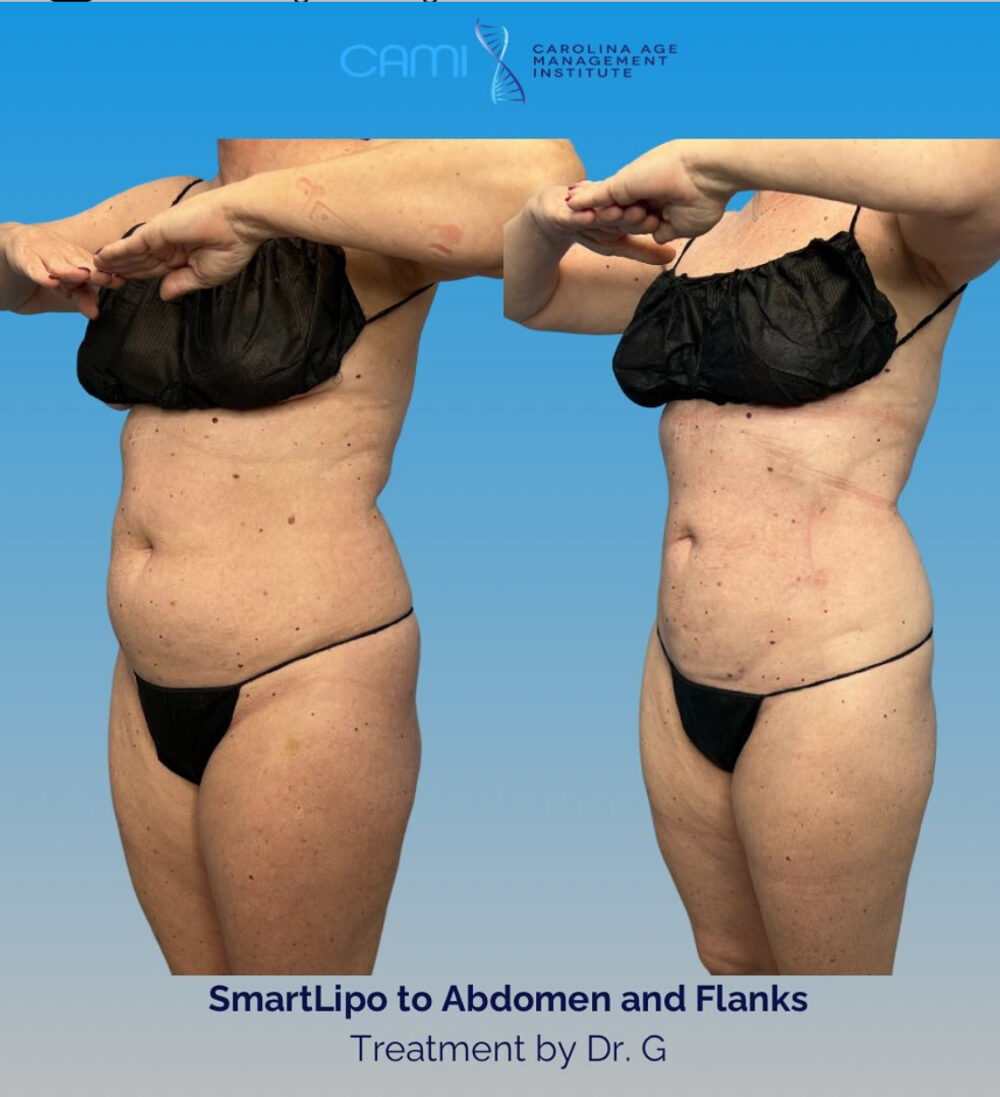 SmartLipo case #72595