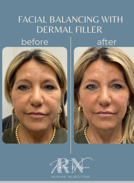 Dermal Fillers case #72495