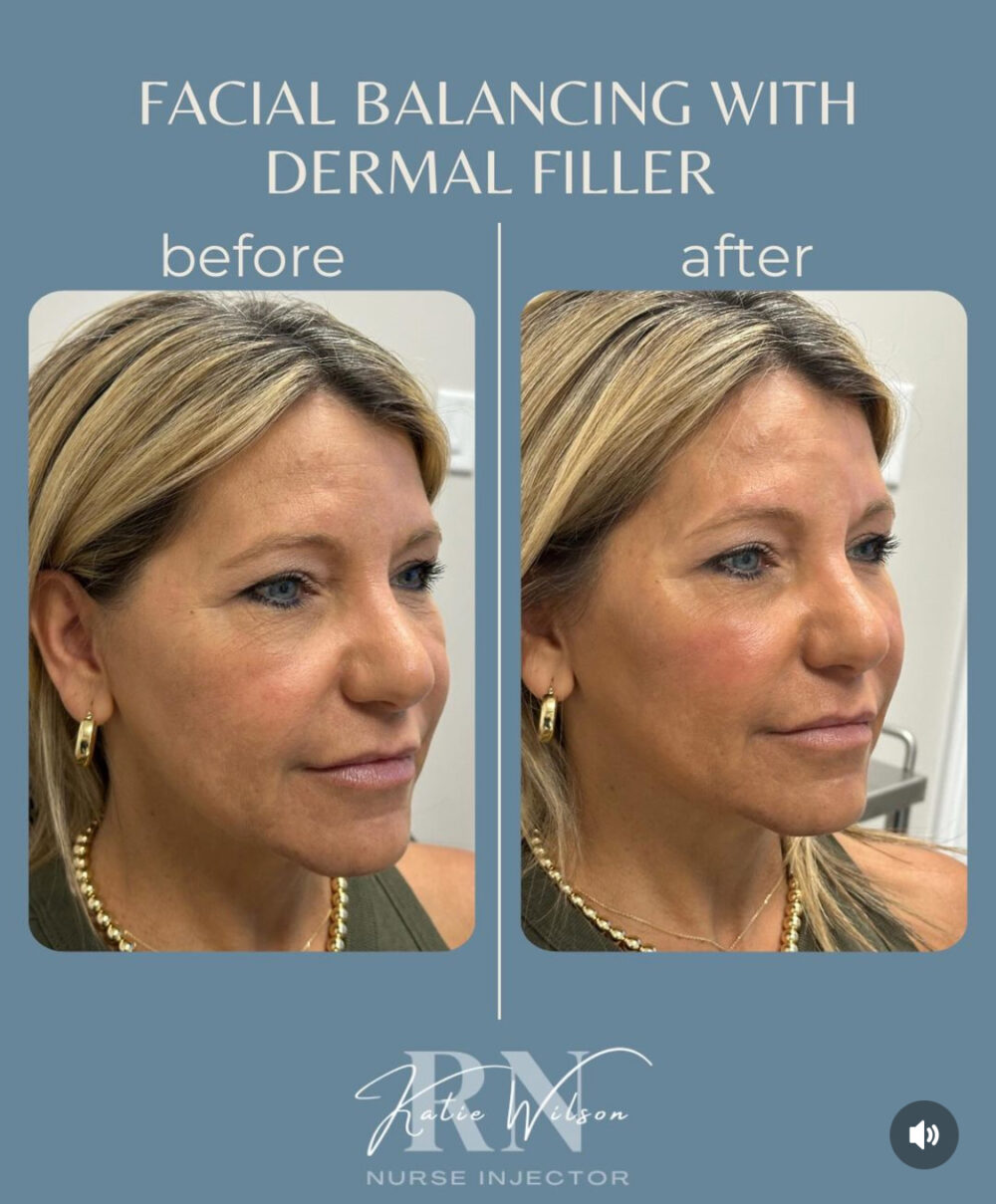 Dermal Fillers case #72495