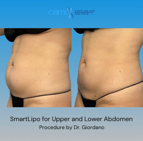 SmartLipo case #72599