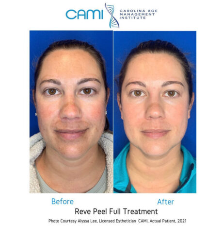 Reve Enlighten Peel case #72677