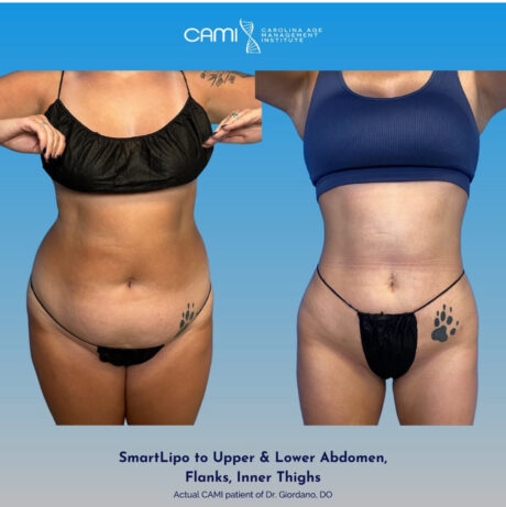 SmartLipo case #72602