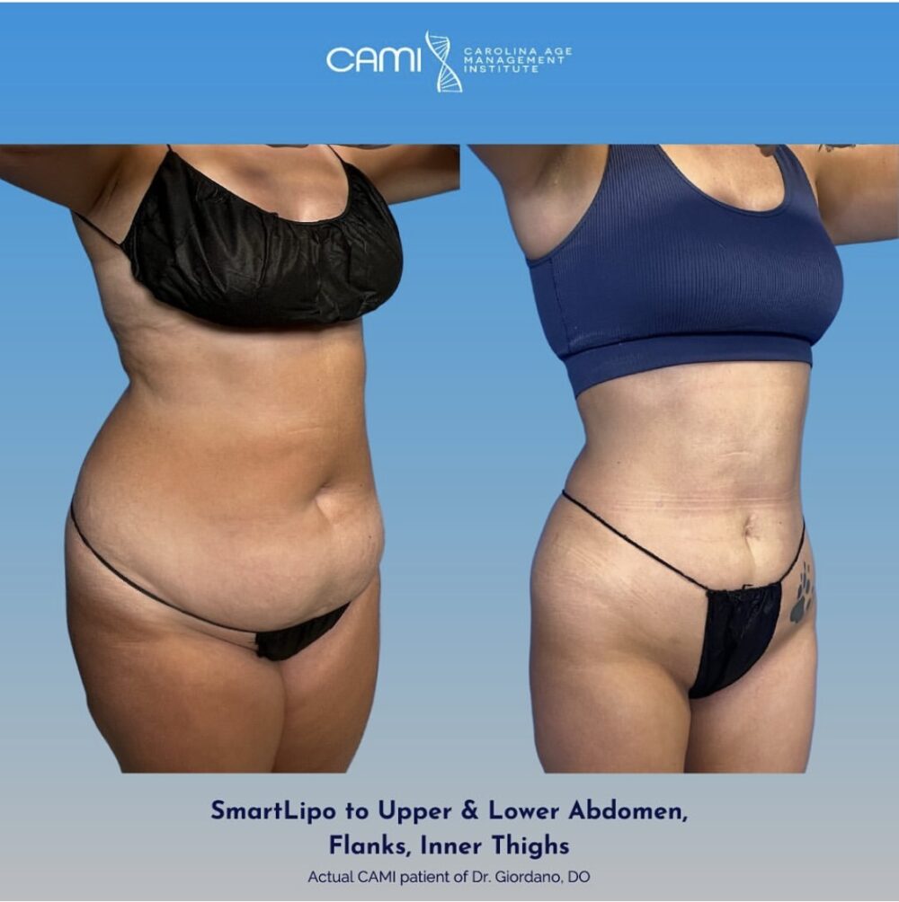 SmartLipo case #72602