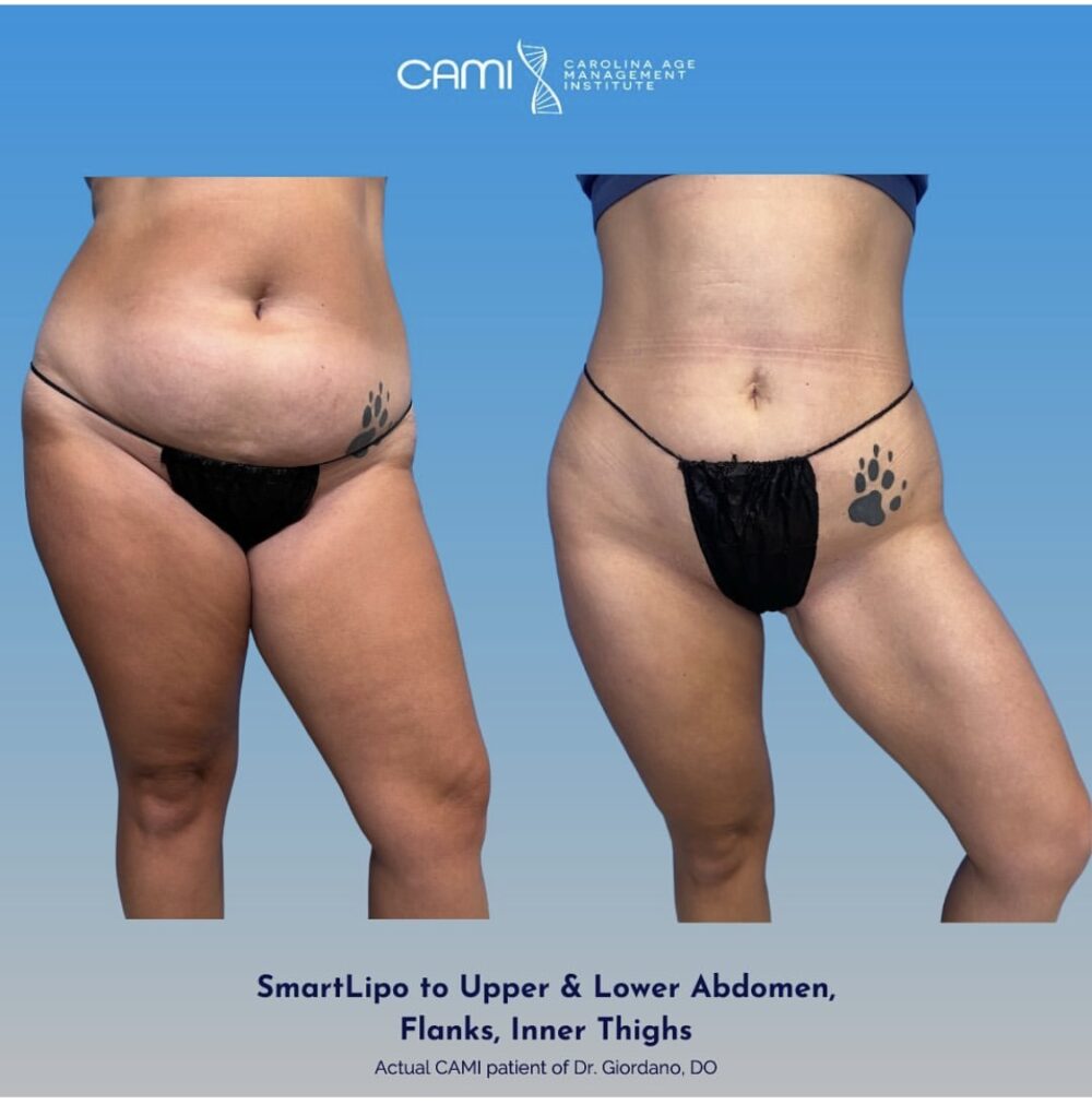 SmartLipo case #72602