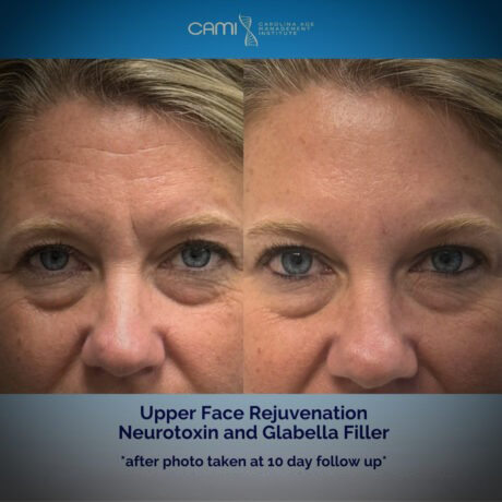 Dermal Fillers case #72506