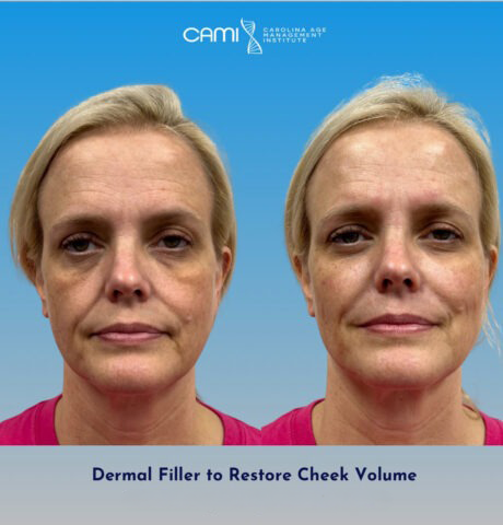 Dermal Fillers case #72502
