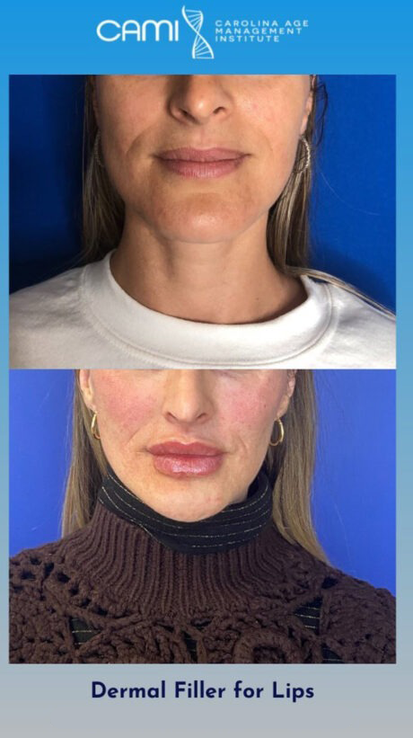 Lip Fillers case #72615