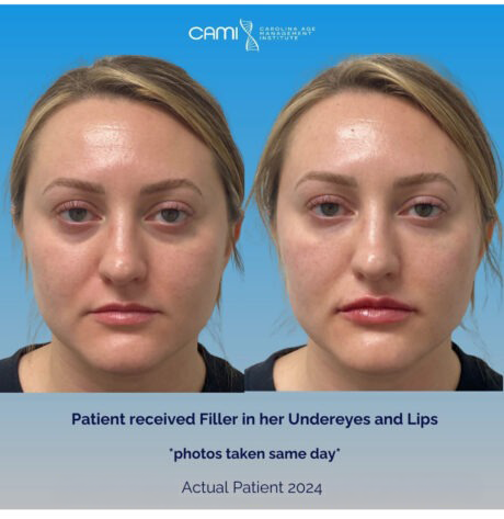 Dermal Fillers case #72519