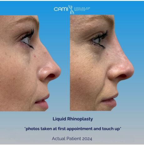 Liquid Rhinoplasty case #72658