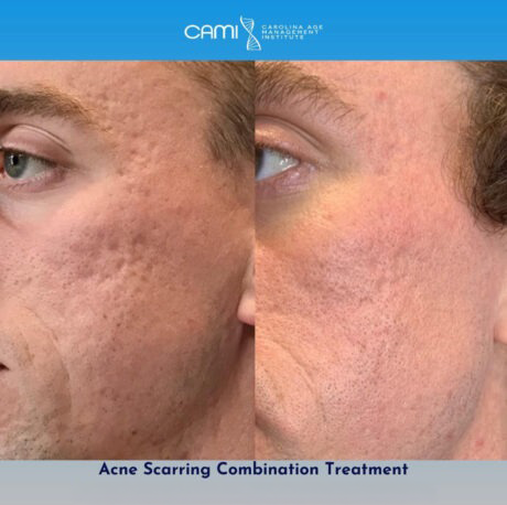 Laser Scar Reduction case #72666