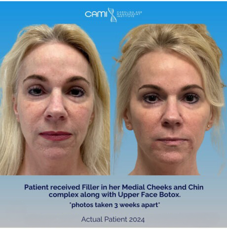 Dermal Fillers case #72517