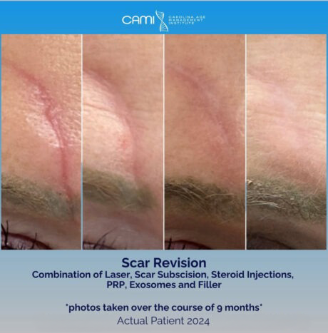 Laser Scar Reduction case #72664