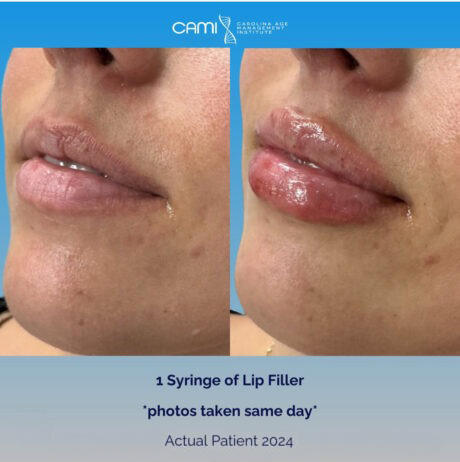 Lip Fillers case #72637