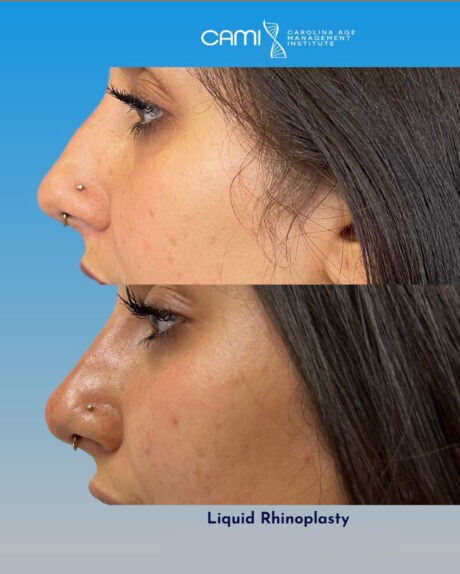 Liquid Rhinoplasty case #72654