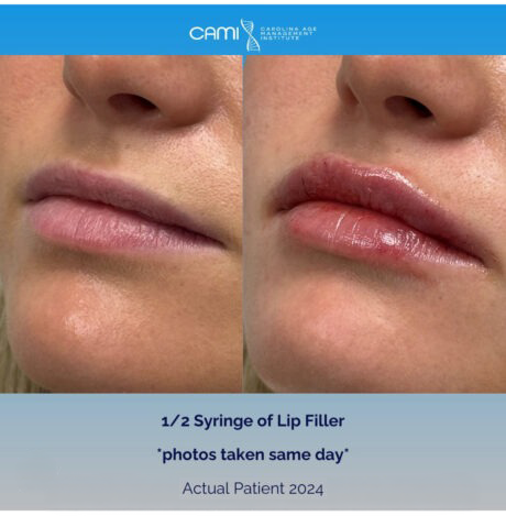 Lip Fillers case #72635