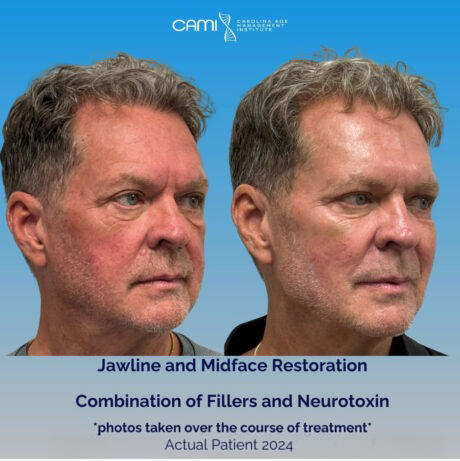 Dermal Fillers case #72513