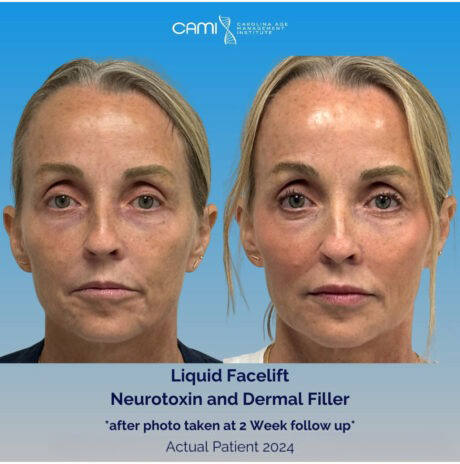 Dermal Fillers case #72511