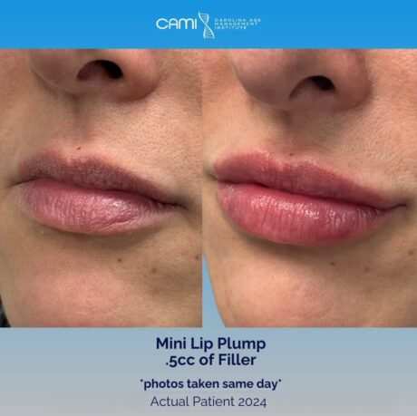 Lip Fillers case #72633