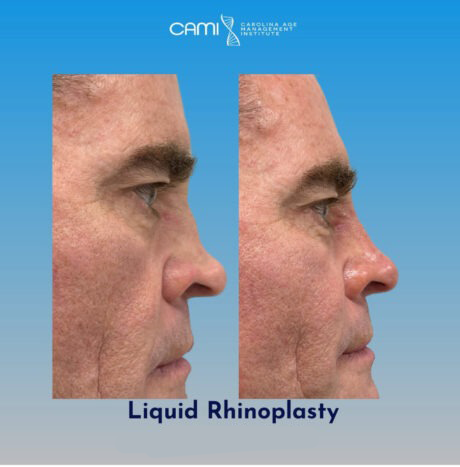 Liquid Rhinoplasty case #72647
