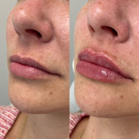 Lip Fillers case #72613