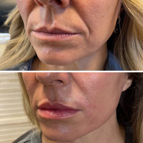 Lip Fillers case #72609