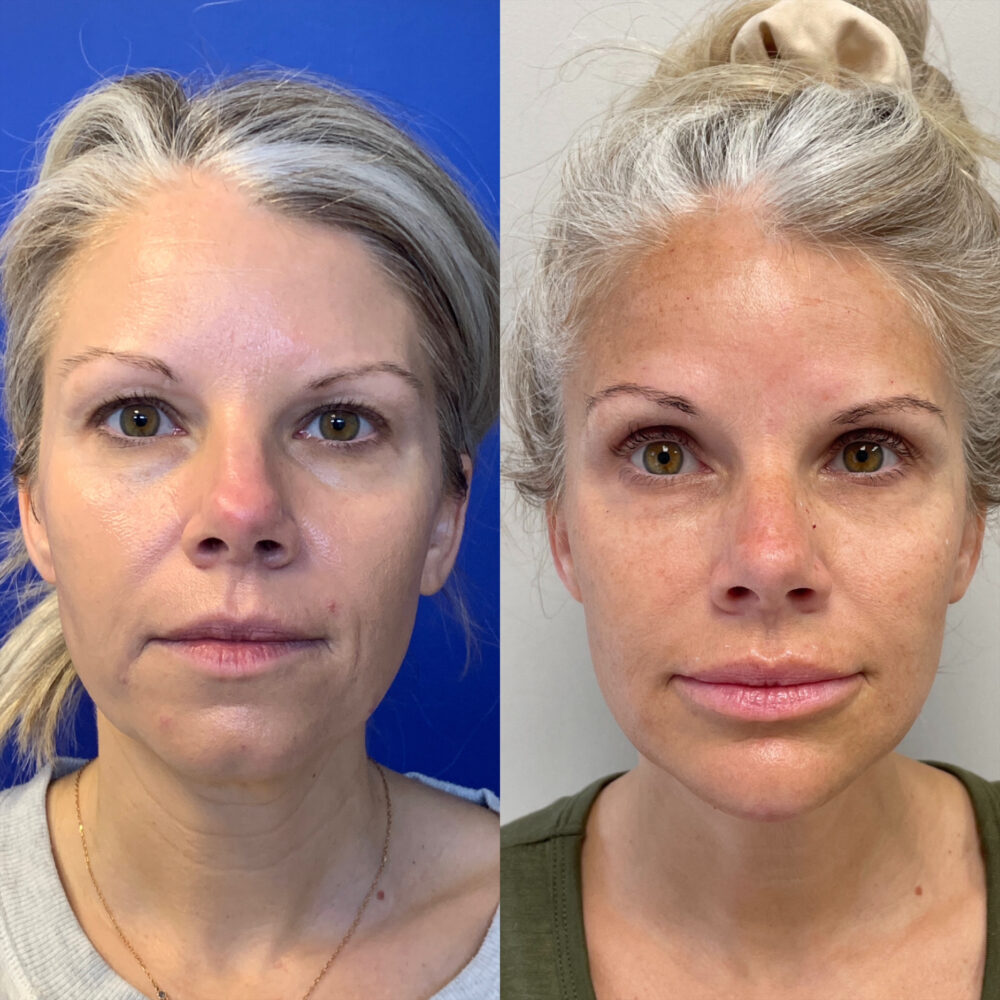 Dermal Fillers case #72489