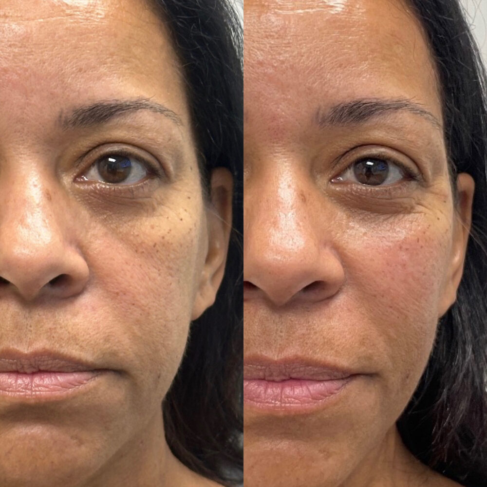 Dermal Fillers case #72487