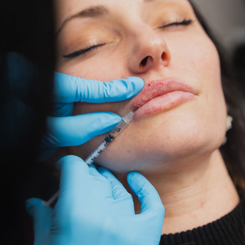 Lip Filler Injecting at Carolina Age Management institute