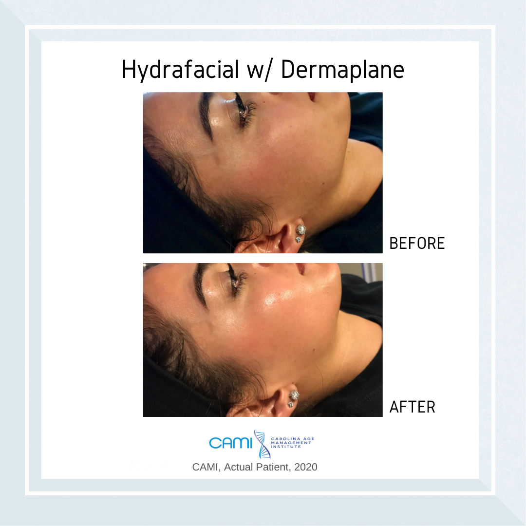 HydraFacial vs Microdermabrasion facial